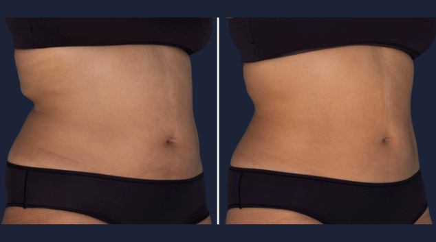 CoolSculpting Elite stomach results